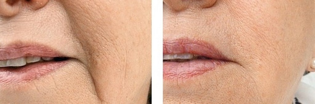 fillermarionettelinesbeforeafte