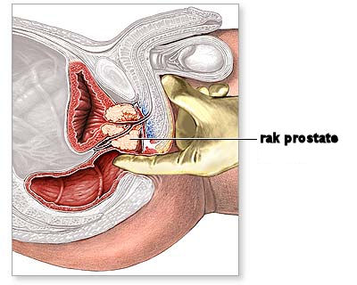 rakprostate2763709
