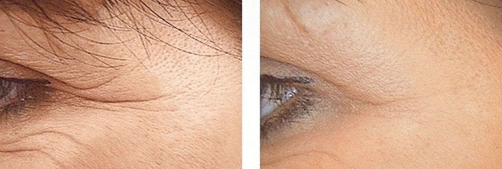 fillerforcrowsfeet1299140