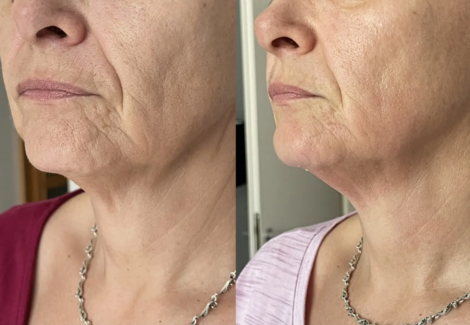 Body and Skin Clinic by EB, INDIBA Čakovec – prije i poslije (1)