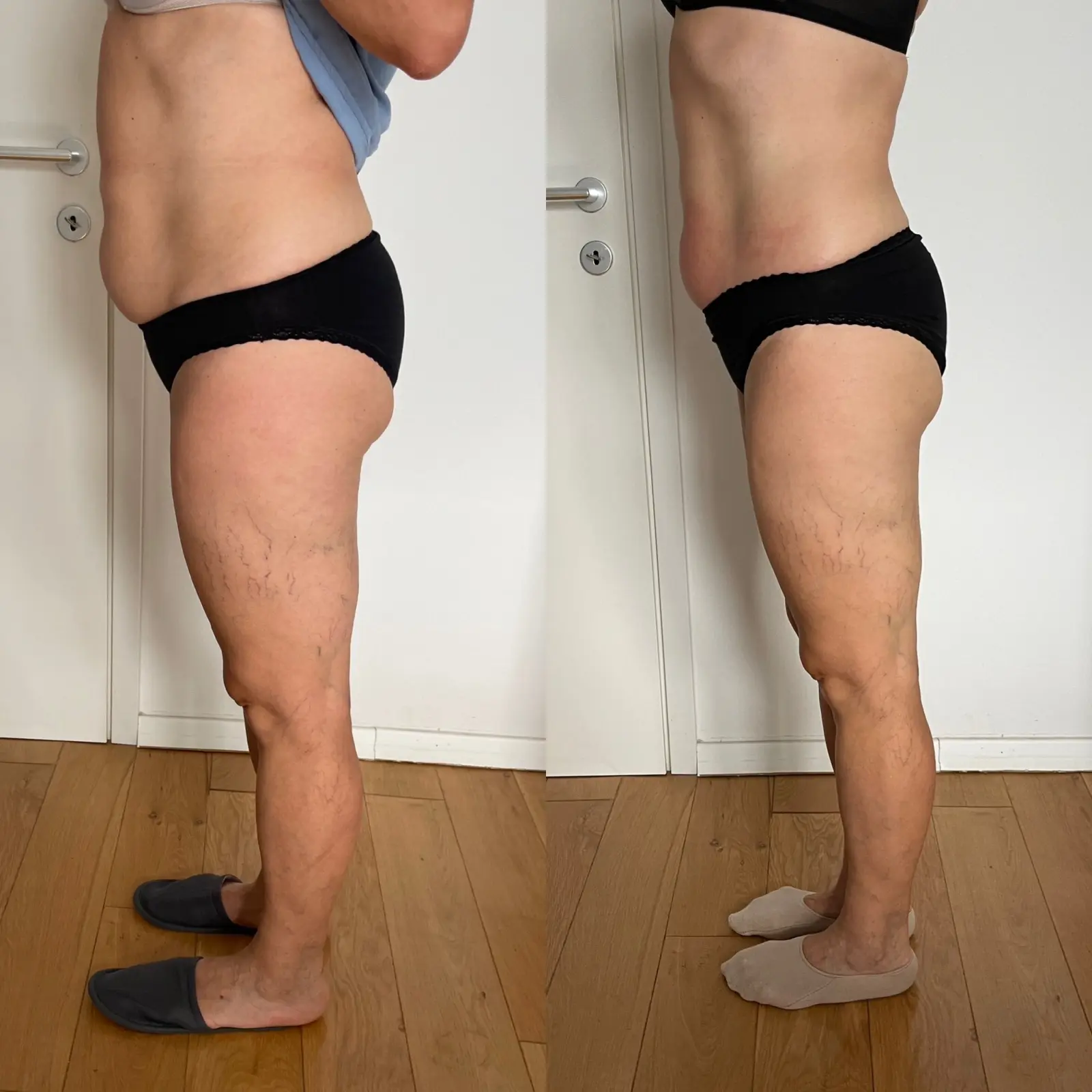 Body and Skin Clinic by EB, INDIBA Čakovec – prije i poslije (2)