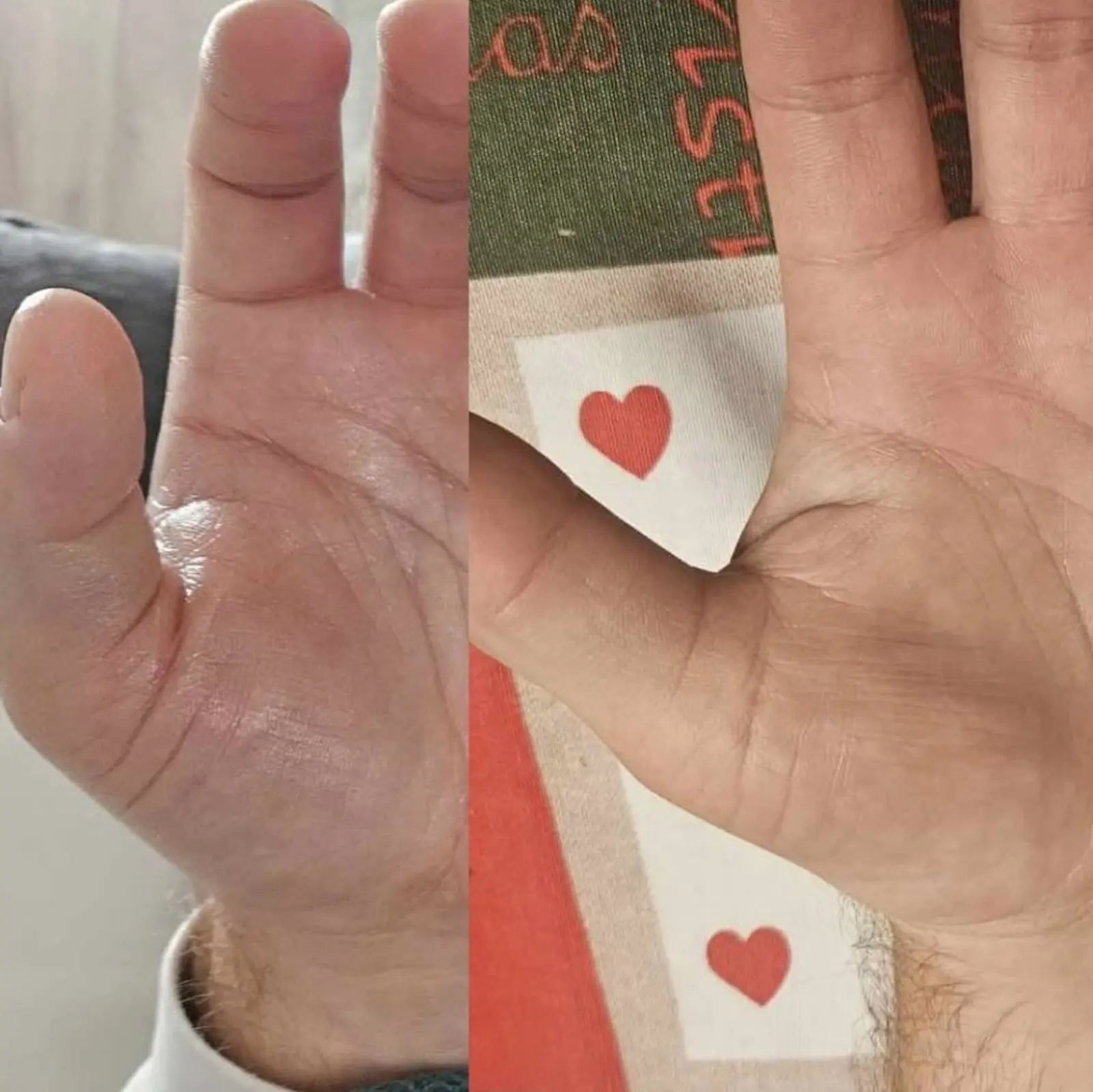 Body and Skin Clinic by EB, INDIBA Čakovec – prije i poslije (3)