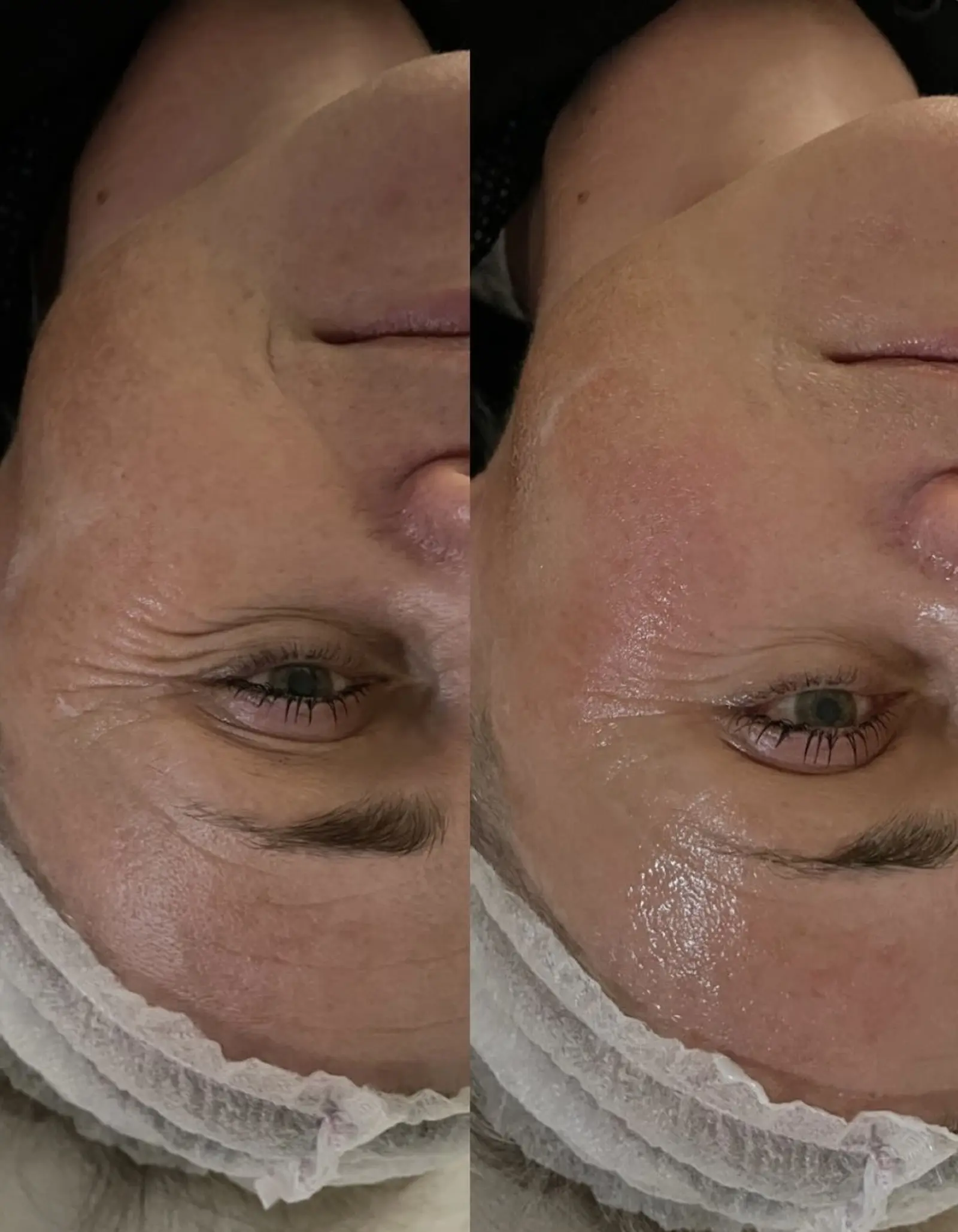 Body and Skin Clinic by EB, INDIBA Čakovec – prije i poslije (4)