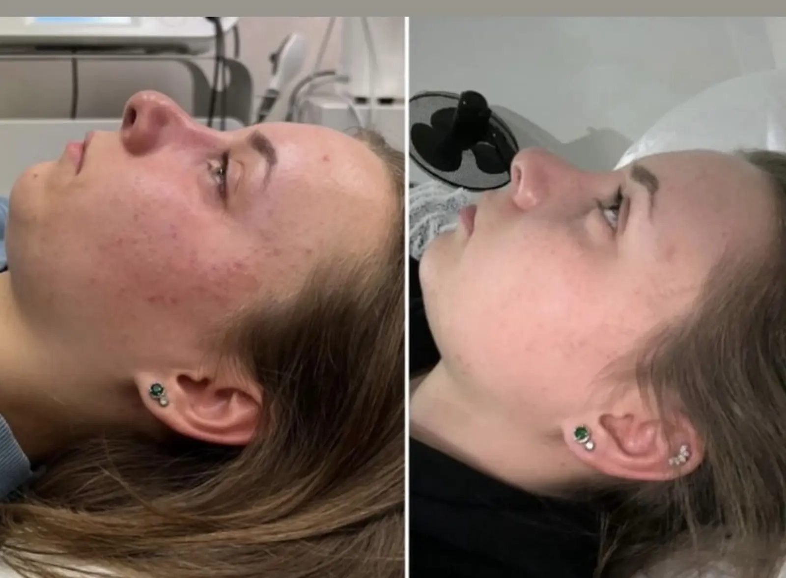 Body and Skin Clinic by EB, INDIBA Čakovec – prije i poslije (5)