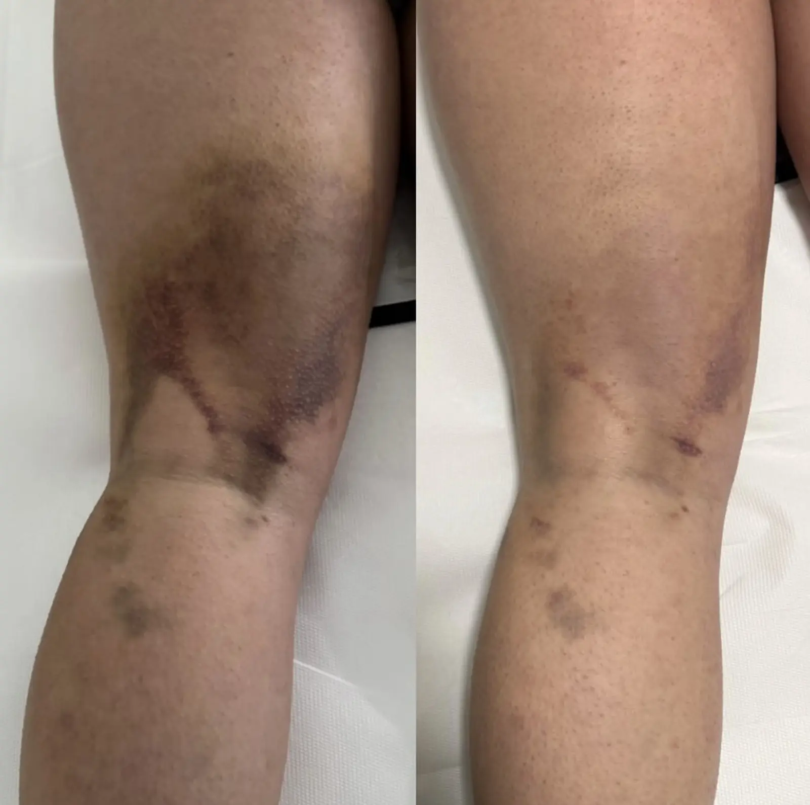 Body and Skin Clinic by EB, INDIBA Čakovec – prije i poslije (6)